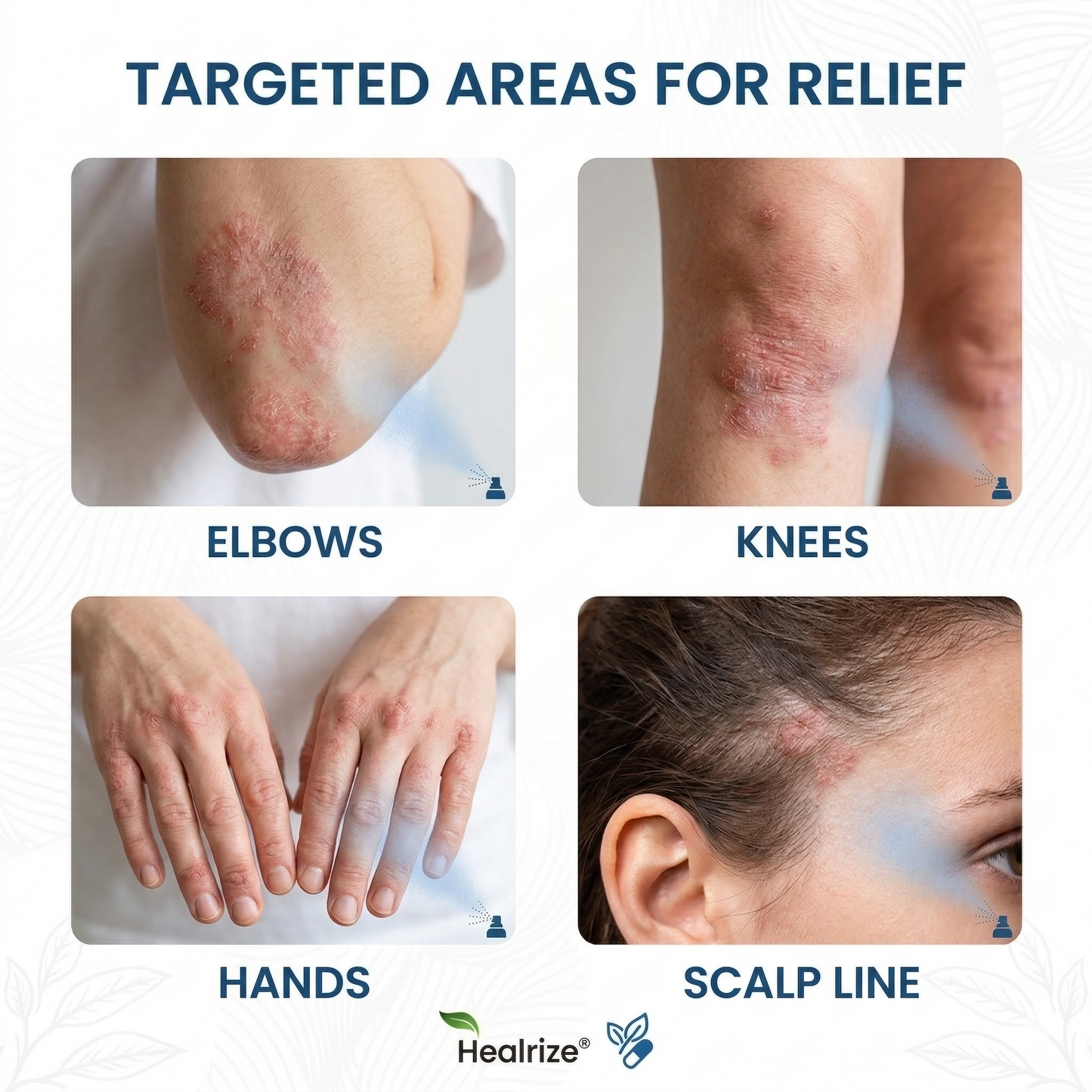 🔥Herbalonix® Magnesium Botanical Spray – Advanced Skin Recovery for Psoriasis & Eczema | Rapid Soothing, Steroid-Free