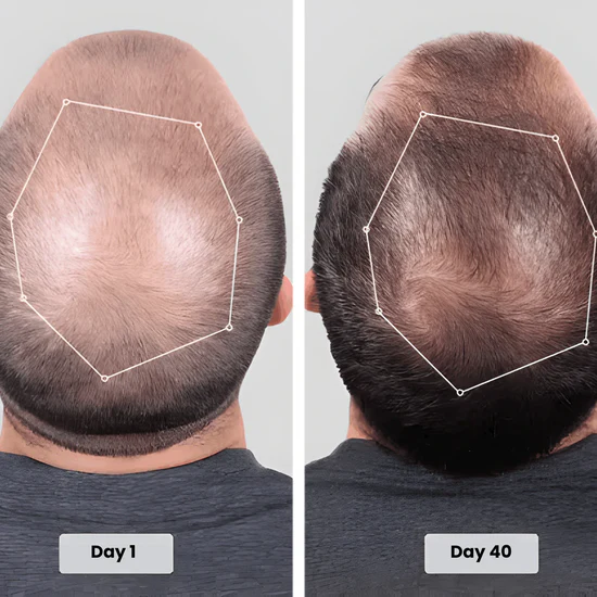 Rovinao before and after result day 40