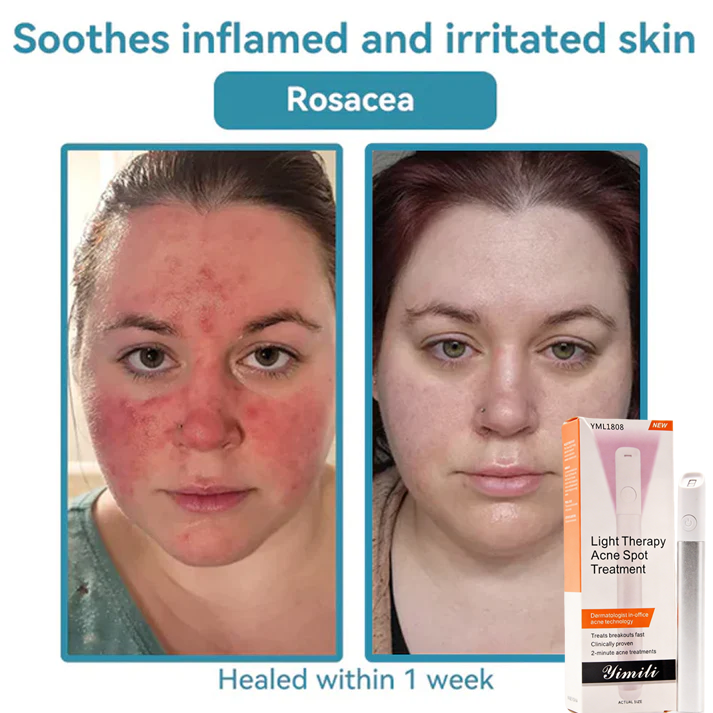💞in-One CO₂ Laser Eraser Pen | Removes Moles, Warts, Skin Flaws & Pigmentation