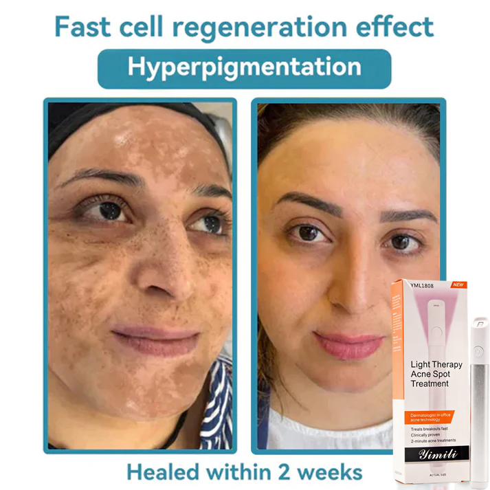 💞in-One CO₂ Laser Eraser Pen | Removes Moles, Warts, Skin Flaws & Pigmentation