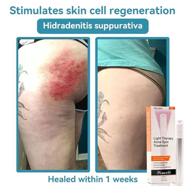 💞in-One CO₂ Laser Eraser Pen | Removes Moles, Warts, Skin Flaws & Pigmentation