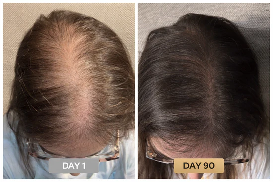 Rovinao before and after result day 90