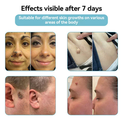 💞in-One CO₂ Laser Eraser Pen | Removes Moles, Warts, Skin Flaws & Pigmentation