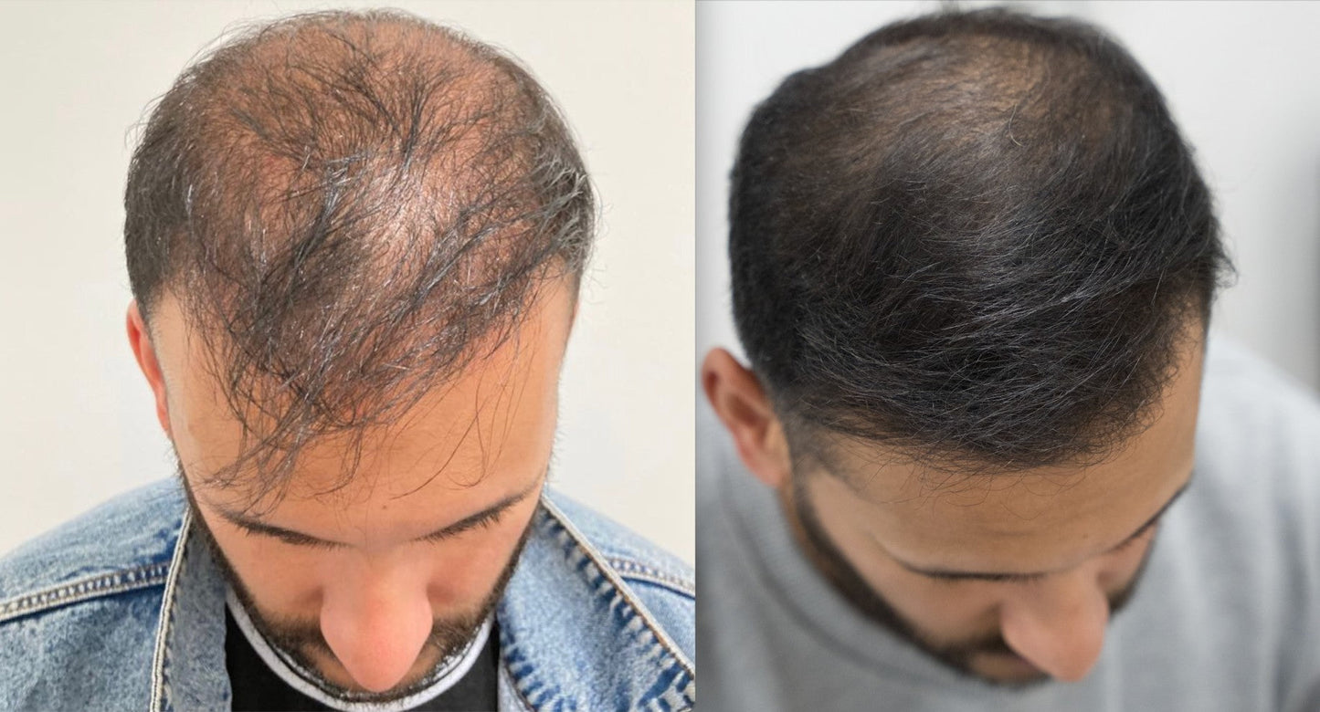 Hair Restoration Spray ( Reawaken Your Roots. Regrow Naturally. ✨ Clinically Proven Hair Regrowth Within 4 Weeks ✨)