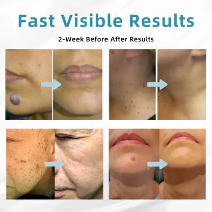💞in-One CO₂ Laser Eraser Pen | Removes Moles, Warts, Skin Flaws & Pigmentation