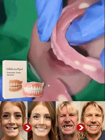 [Epic Upgrade] Premium Full Cover Dentures
