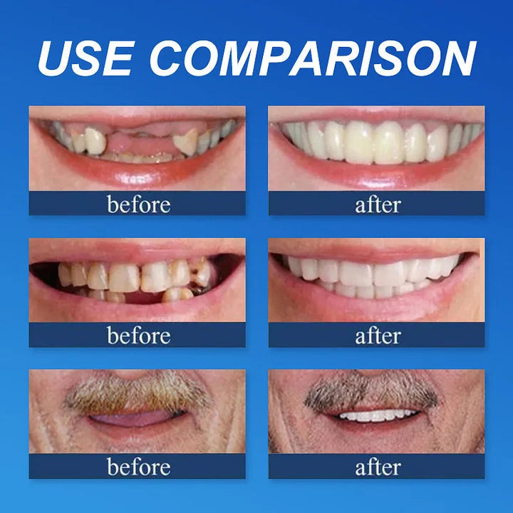 Ends Today: 70% OFF  Custom-Fit Full Functional Dentures