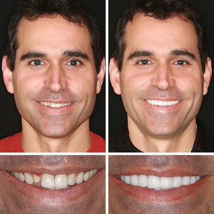 Ends Today: 70% OFF  Custom-Fit Full Functional Dentures