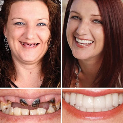 Ends Today: 70% OFF  Custom-Fit Full Functional Dentures