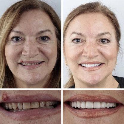 Ends Today: 70% OFF  Custom-Fit Full Functional Dentures