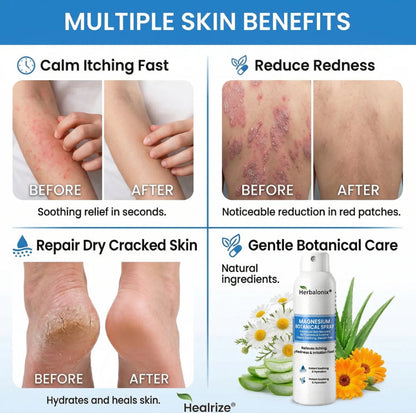 🔥Herbalonix® Magnesium Botanical Spray – Advanced Skin Recovery for Psoriasis & Eczema | Rapid Soothing, Steroid-Free
