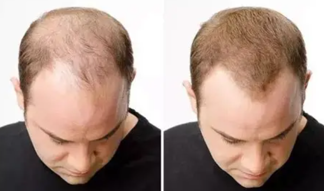 Lovilds® Hair Restoration Spray ( Reawaken Your Roots. Regrow Naturally. ✨ Clinically Proven Hair Regrowth Within 4 Weeks ✨)