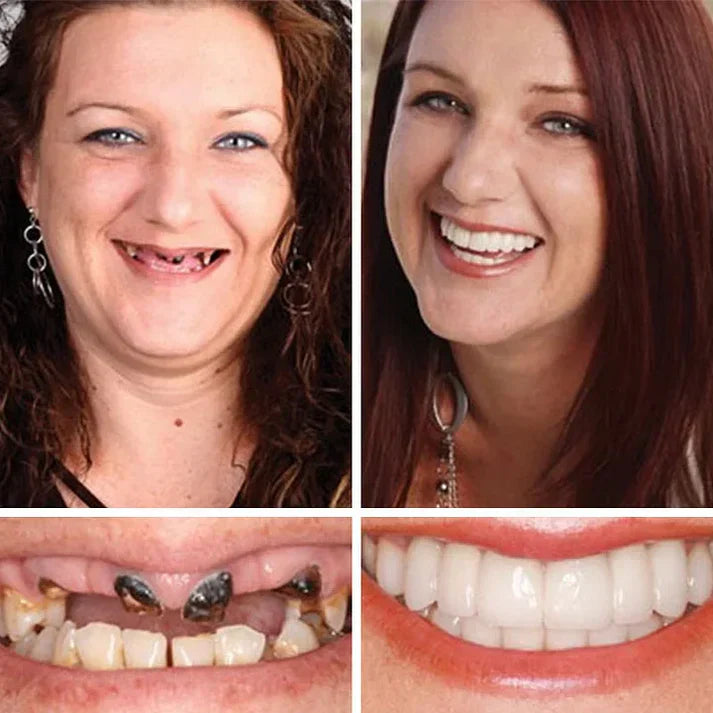 🏆2026 Bestselling Product🦷 Fit for a Fresh Smile, Say Goodbye to Wearing Discomfort!🌎