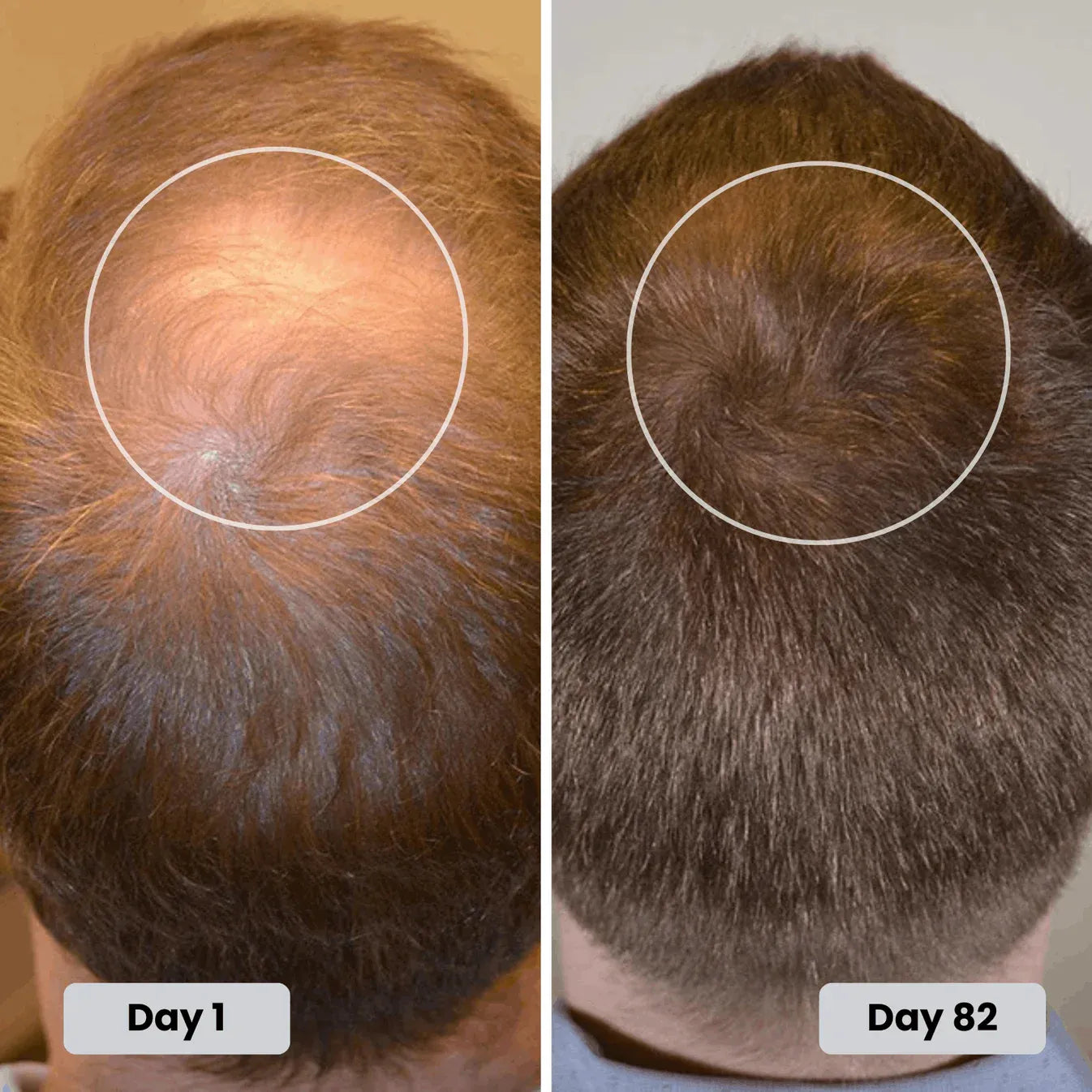 Torven Hair Regrowth Red Light Therapy